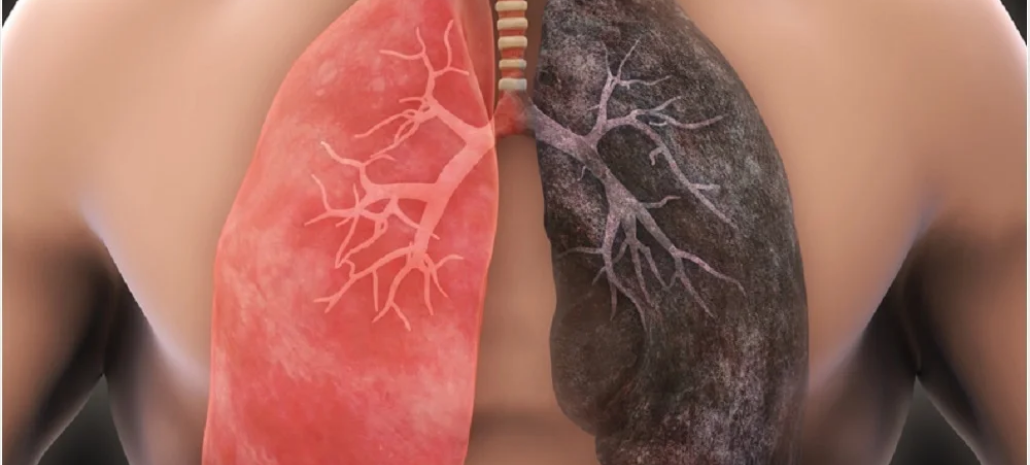 lung cancer specialist in Delhi NCR