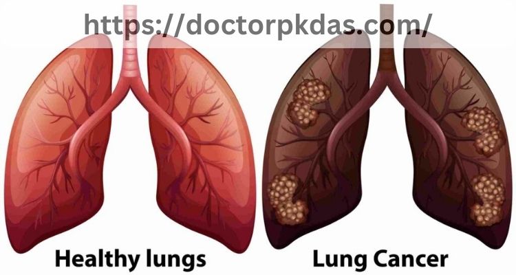 Getting screened for lung cancer